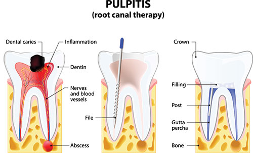root canal Lake Worth