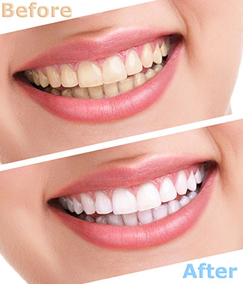 whitening in Lake Worth