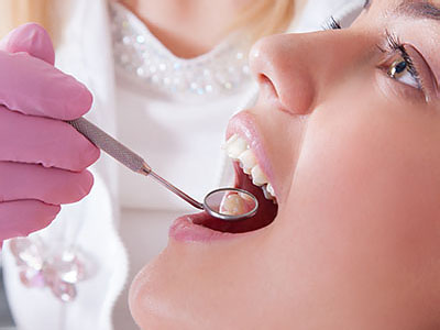 dental fillings in Lake Worth