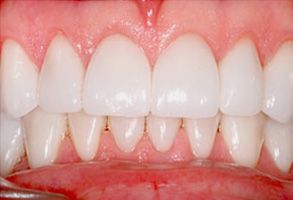 Emergency Dentist Lake Worth