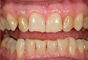 Emergency Dentist Lake Worth
